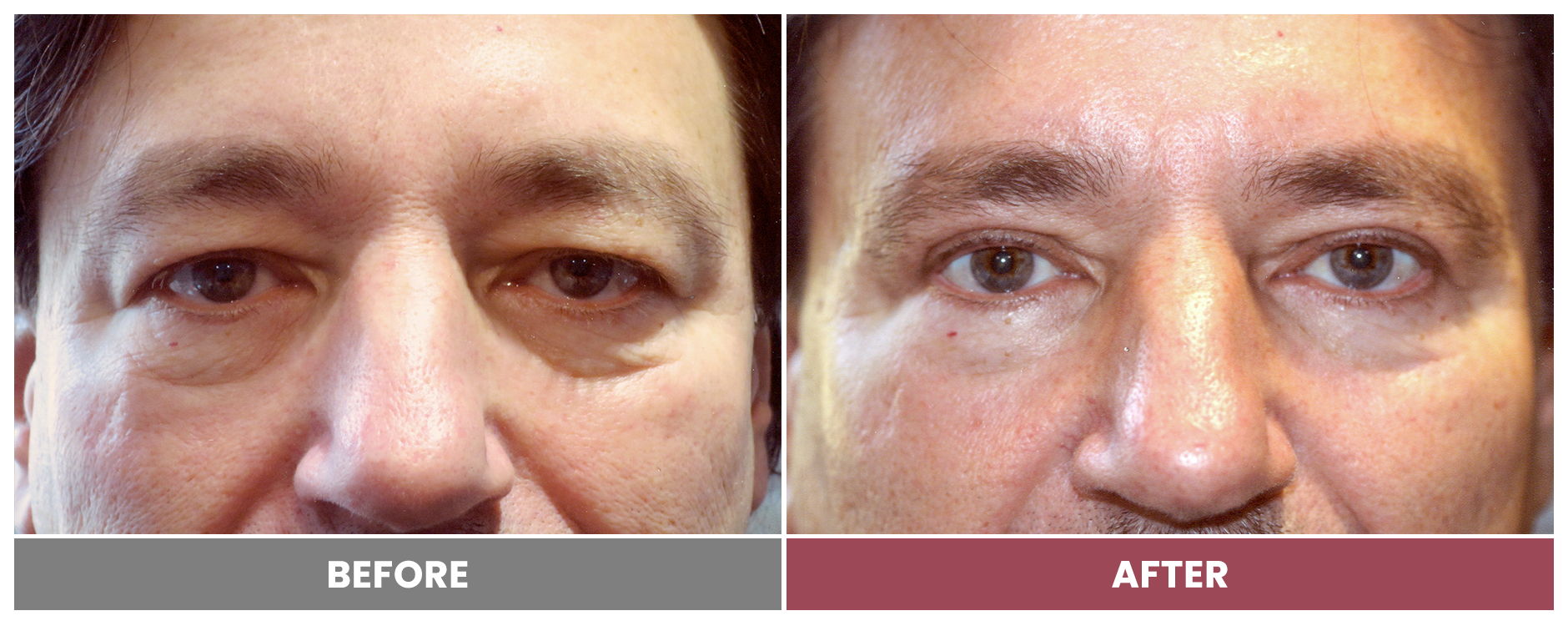 Upper Blepharoplasty - Case 16